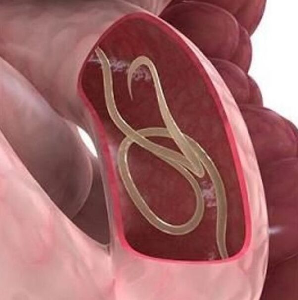 Známky červov u osoby v gastrointestinálnom trakte